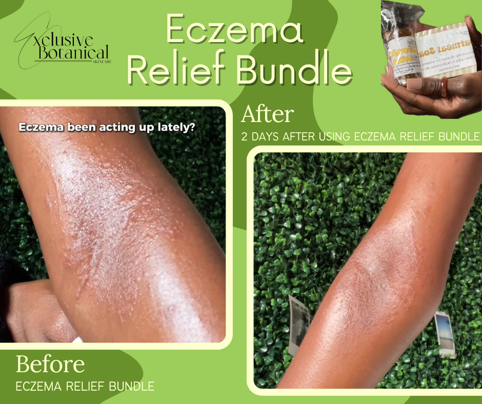 Eczema Relief