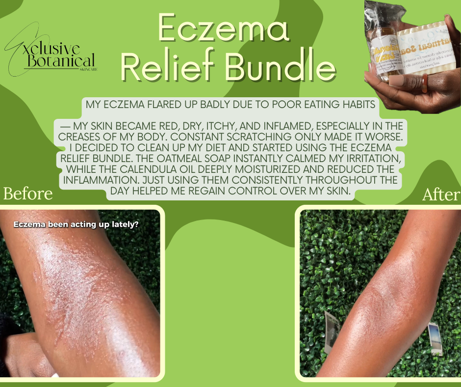 Eczema Relief